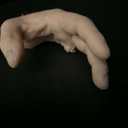 Lacerated Hand